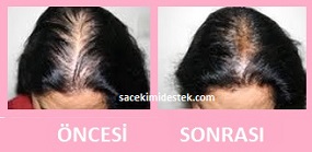 saç mezoterapisi öncesi ve sonrası 24