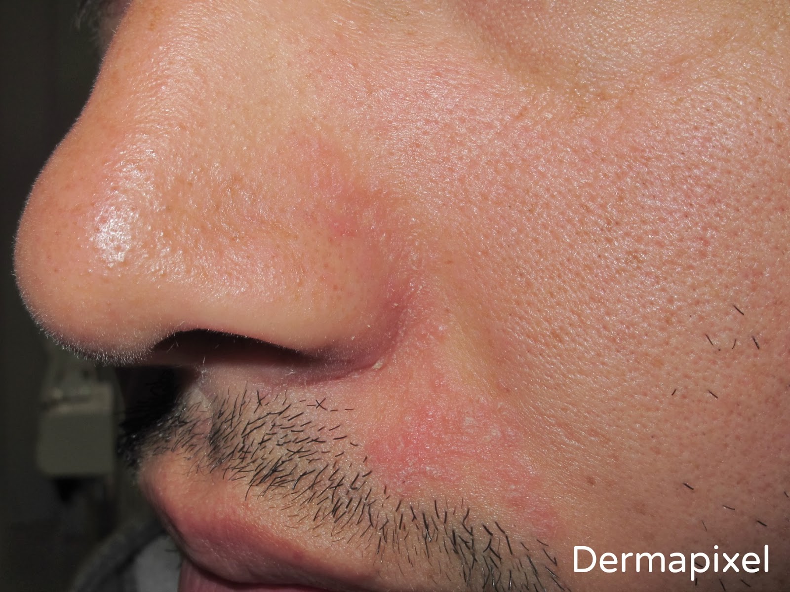 Dermapixel: Dermatitis seborreica: No es piel