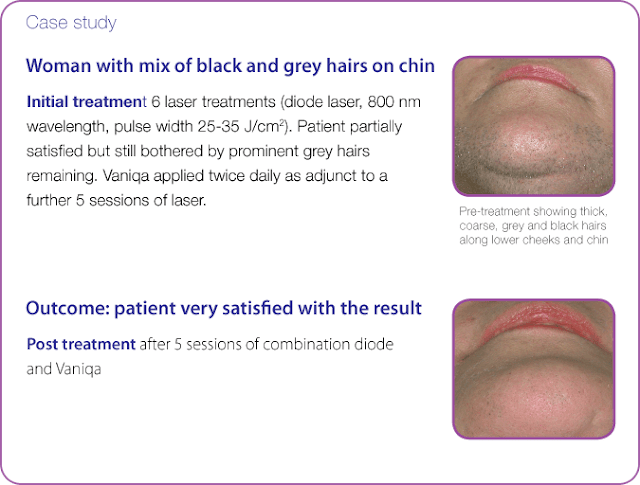 hirsutism, pcos and increased facial hair