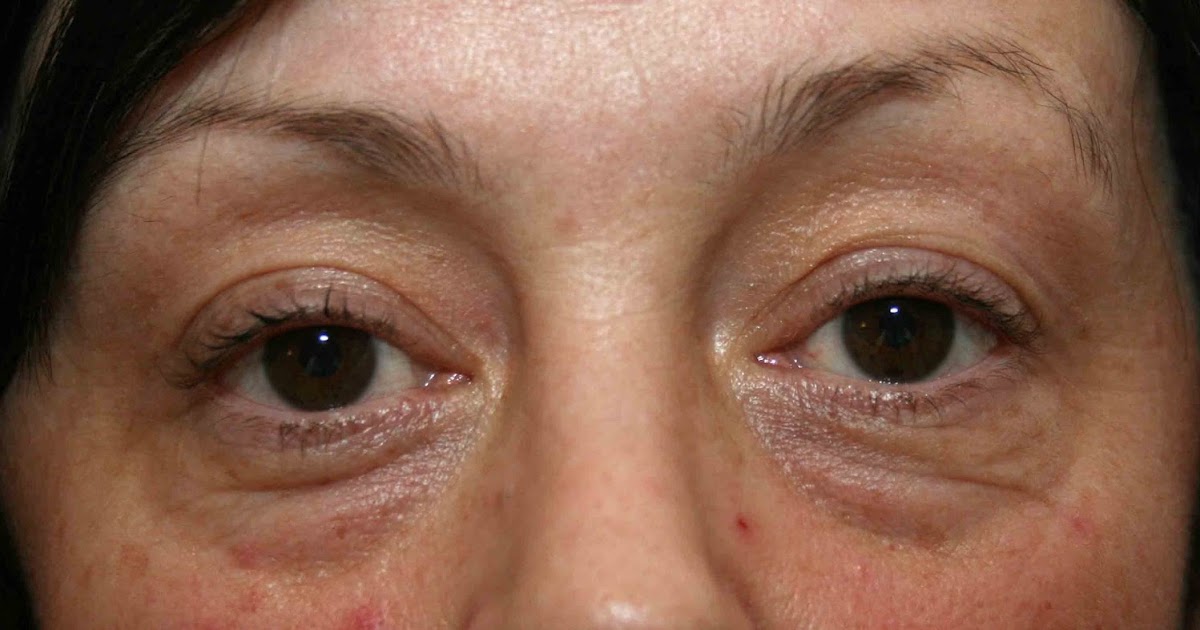 Facial Exercises For Firming Jowls And Face Skin And Reducing Lines