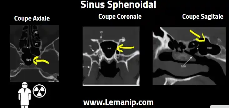 Anatomie Et Coupes Scanner Des Sinus Sphenoidal