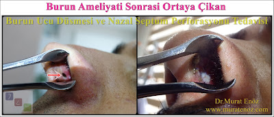 Nasal septal perforation - Repair of nasal septal perforation - Nasal septum perforation - Septal perforation - Surgical treatment of nasal septal perforation - Septal perforation repair surgery in Istanbul - Perforated septum treatment in Turkey