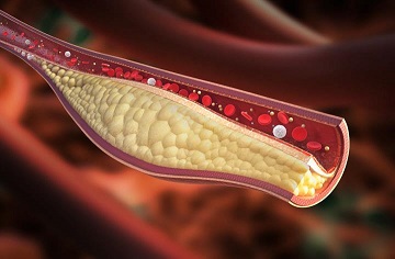 High Cholesterolv