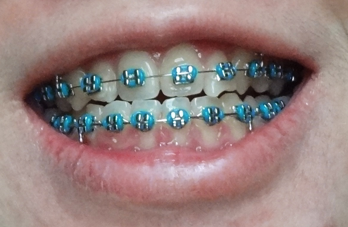 Pin By Fabi On Braces Colors Cute Braces Colors Braces Teeth Colors