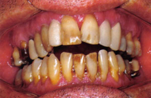 O refrigerante estraga os dentes como as drogas. ~ O Meu Mundo Louco