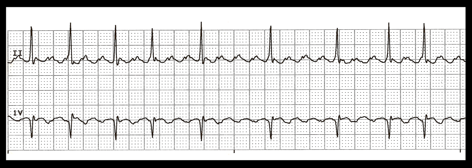 2 1 atrial flutter 2 1 atrial flutter