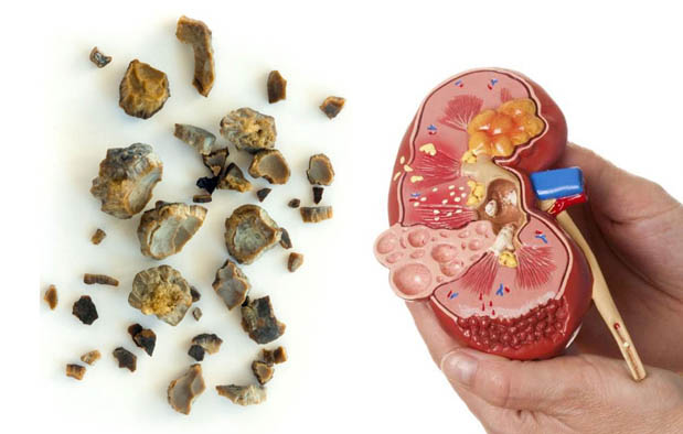 Daftar Kelainan Pada Ginjal Gambar Dan Penjelasannya Belajar Belajar Wirausaha