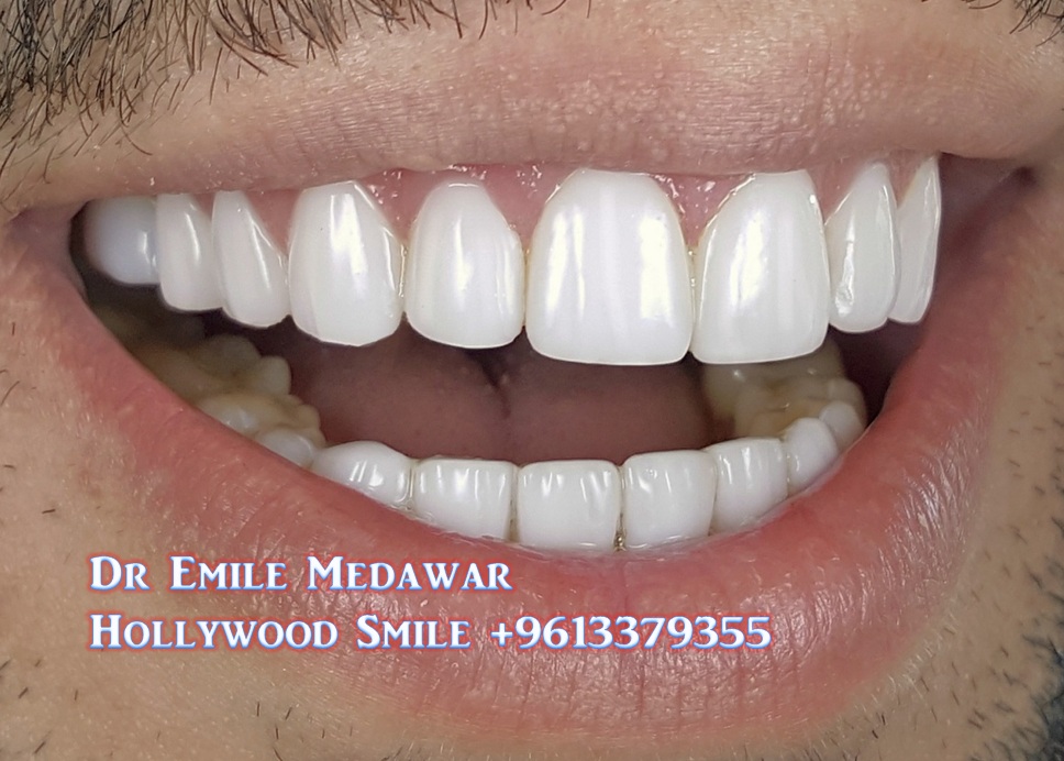 Veneers, Dental Implants, Gummy Smile, Laser Dentistry, EMax, Zirconium, Full Ceramic