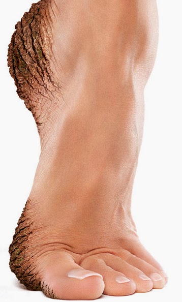 Τέλος οι σκασμένες φτέρνες και κάλοι No more cracked heels and calluses