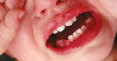 Nguyên nhân gây áp xe răng là gì