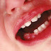 Nguyên nhân gây áp xe răng là gì