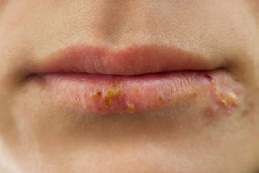 Herpes en las axilas causas