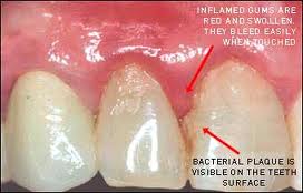gingival hpv treatment)