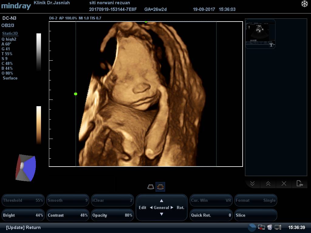Klinik Scan Baby Melaka Apa beza 2D, 3D, 4D, 5D & 6D Ultrasound Scan