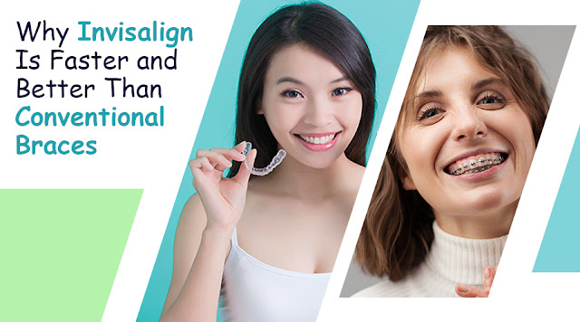 invisalign braces