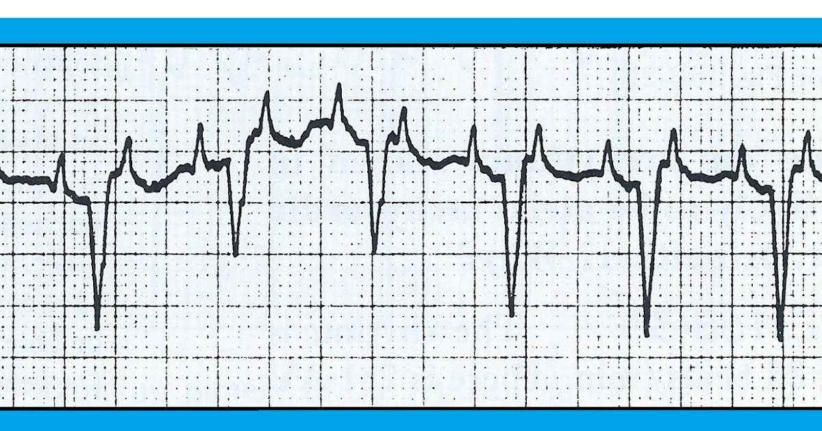 ECG Interpretation: ECG Blog #138 (SVT – AV Block – Atrial Flutter ...