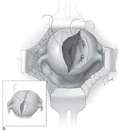 Removal of fibroid from myometrium