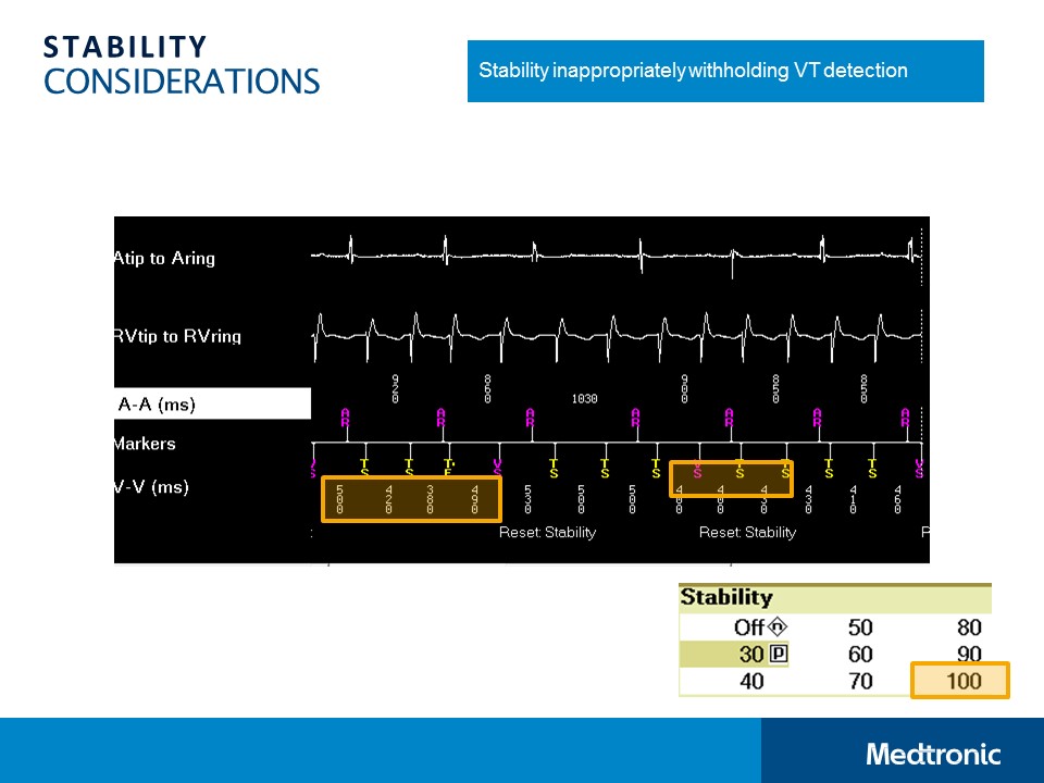 CVT Mohd Farid: Concept Of ICD Technology-SVT Discrimination Algorithms ...