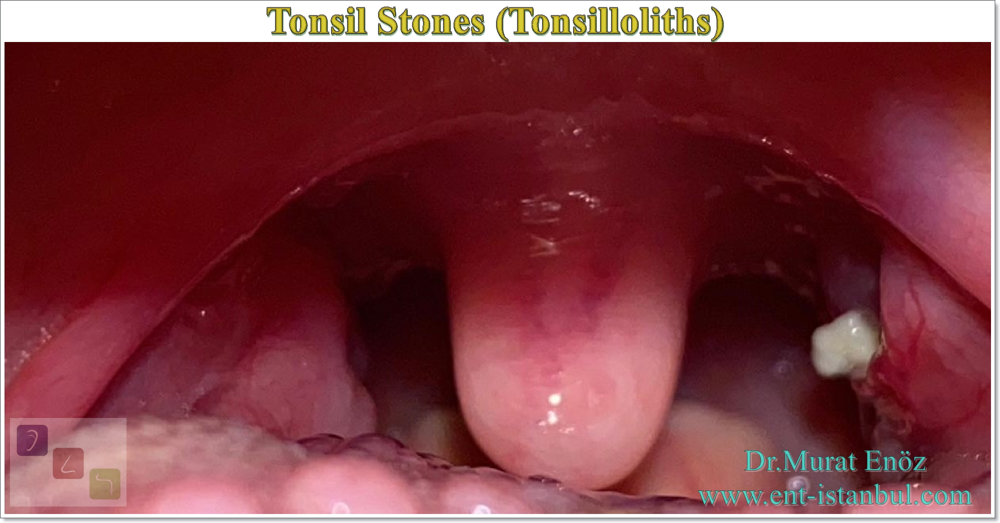 tonsil stone removal