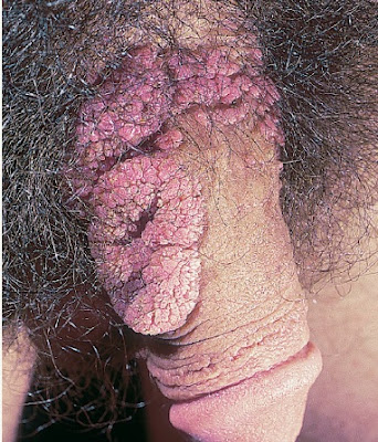 Neglected penile warts progressing to giant condylomata.  