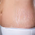 The Best Treatments For Old Stretch Marks