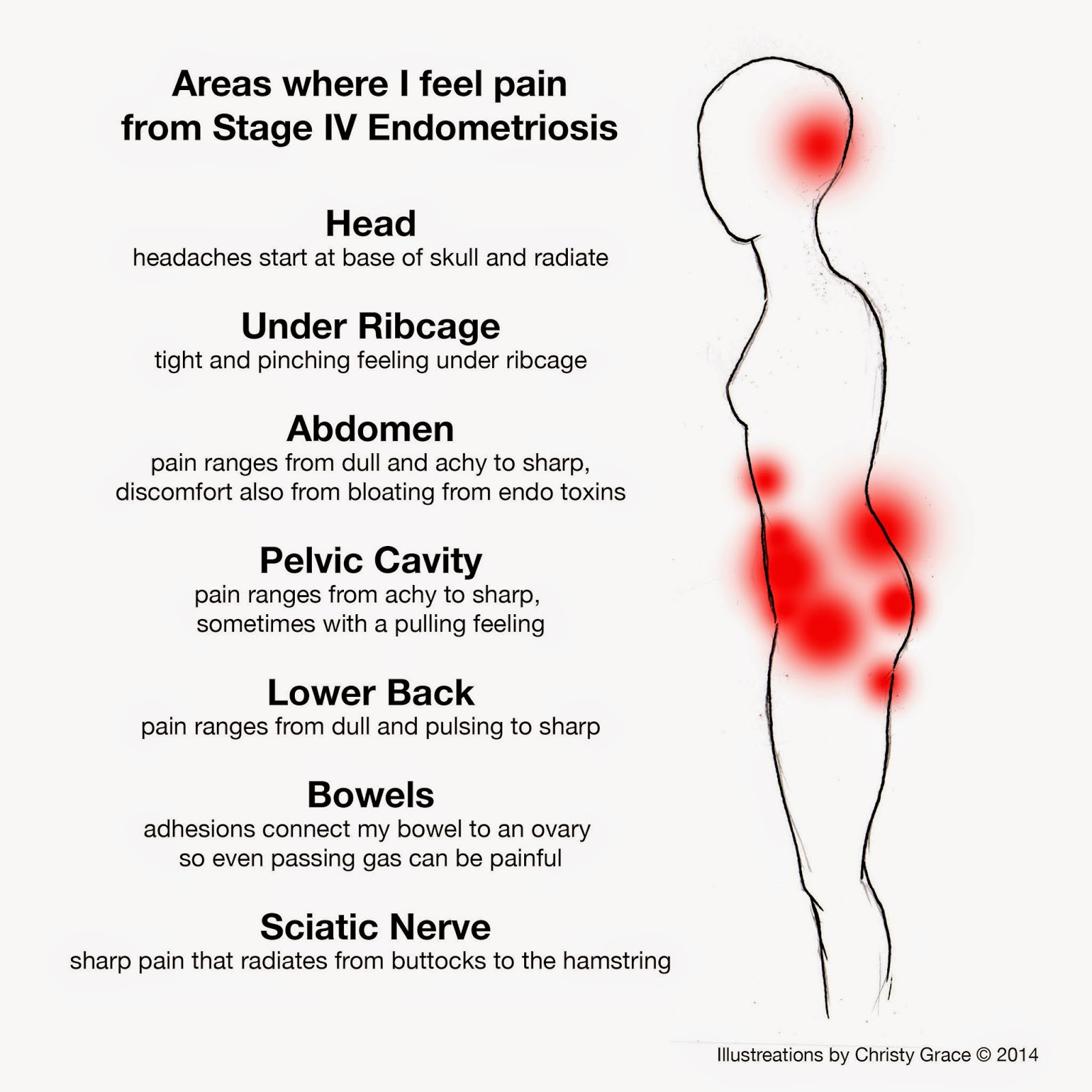 Symptoms of endometriosis in abdominal wall, ed westwick instagram ...