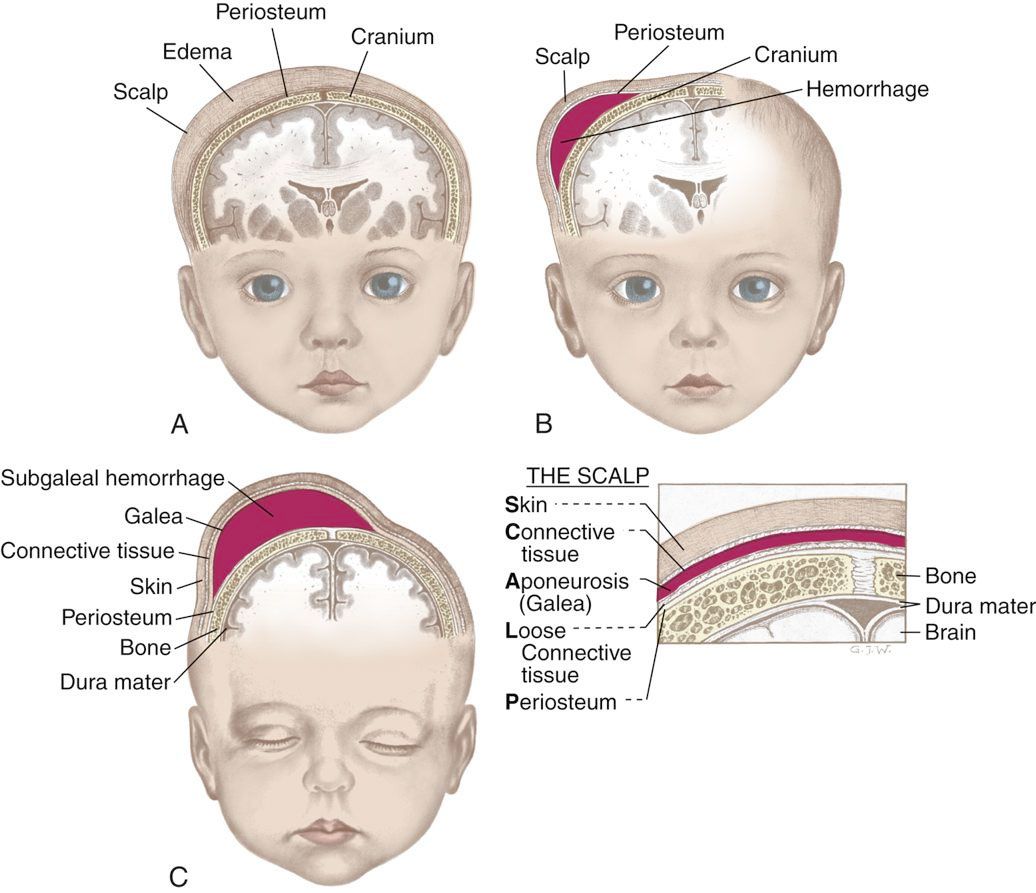 Difference between Caput Succedaneum and Cephalhematoma - How to Heal