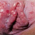 Ciri Ciri Herpes di Vagina | Obat Herpes