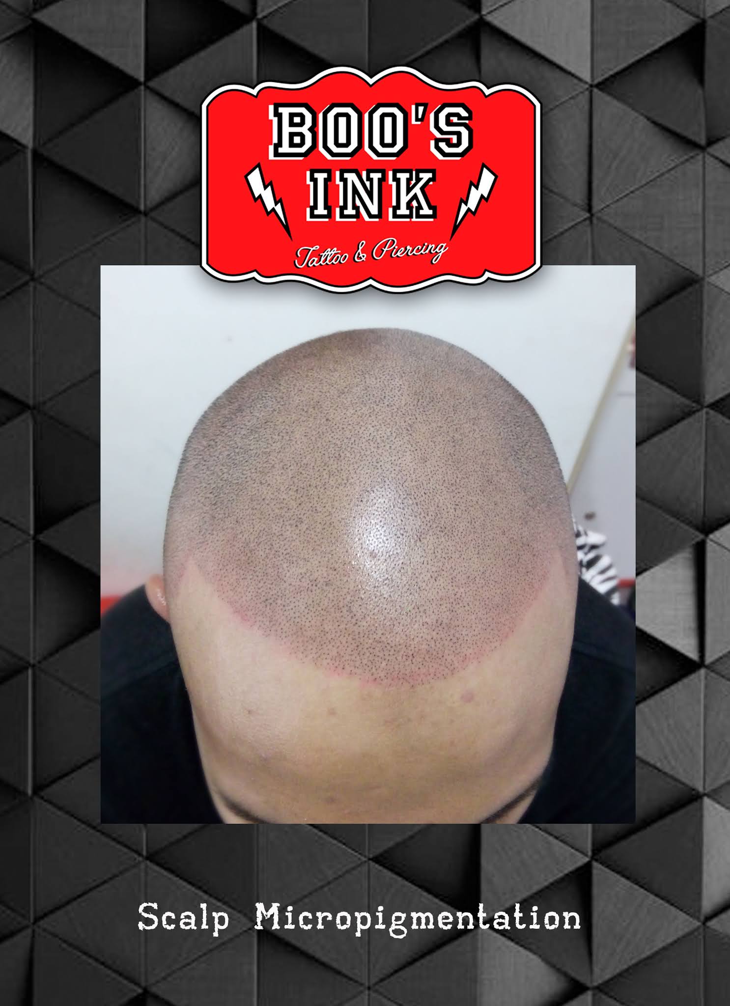 Scalp Micropigmentation Treatment Jakarta
