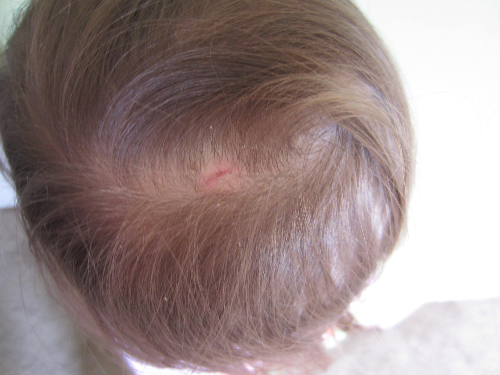 Head Lice Eggs, Nits | Lice Egg Picture