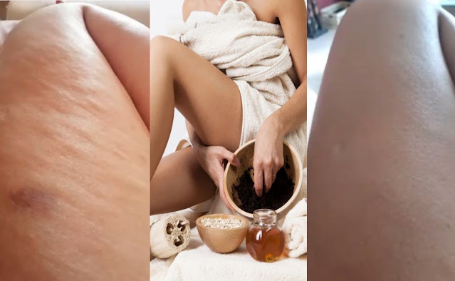 Pour en finir avec la cellulite repidement voilà la solution définitive