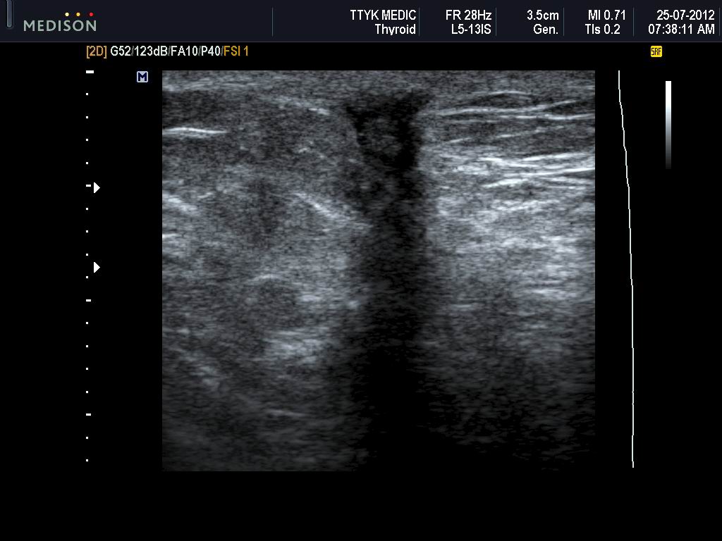 VIETNAMESE MEDIC ULTRASOUND CASE 133 SCAR of REMOVED BREAST TUMOR, Dr