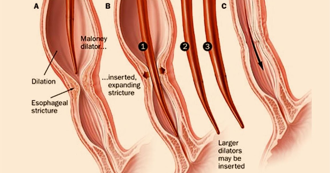Stricture (Esophageal) Dilation by Vishwa Gastro & Liver Clinic