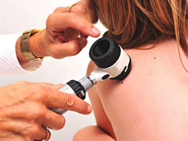 5 factors that increase the risk of skin cancer