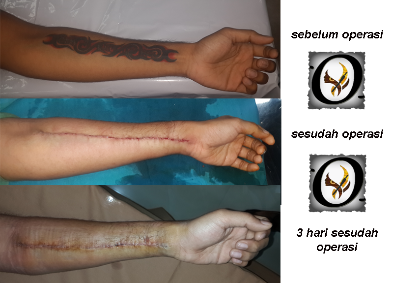 Klinik Online Bedah Plastik Menghilangkan Tatto (Tato) di Kulit