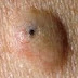Is Epdermal cysts?