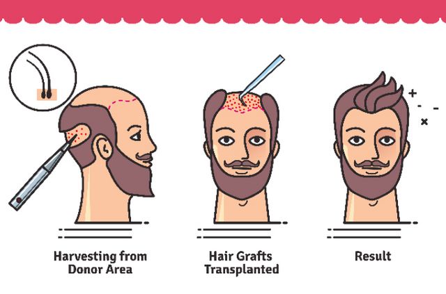 How Does Hair Transplant Surgery Work Complete Procedure