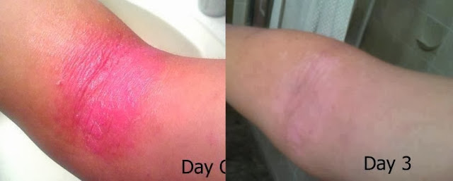 NuCerity Asia Skincerity Skincerity A Treatment for Eczema?