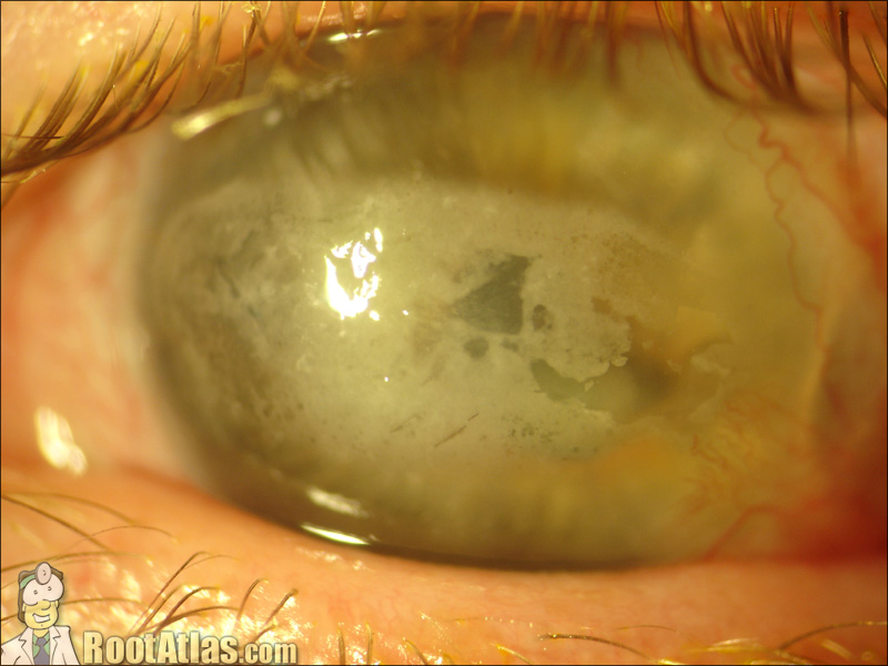 Xử trí bệnh GIÁC MẠC DẢI BĂNG bằng phương pháp EDTA chelation Band