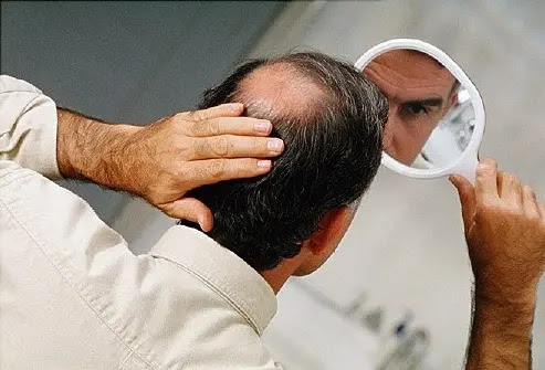 Common causes of hair loss in men Common causes of hair loss in men