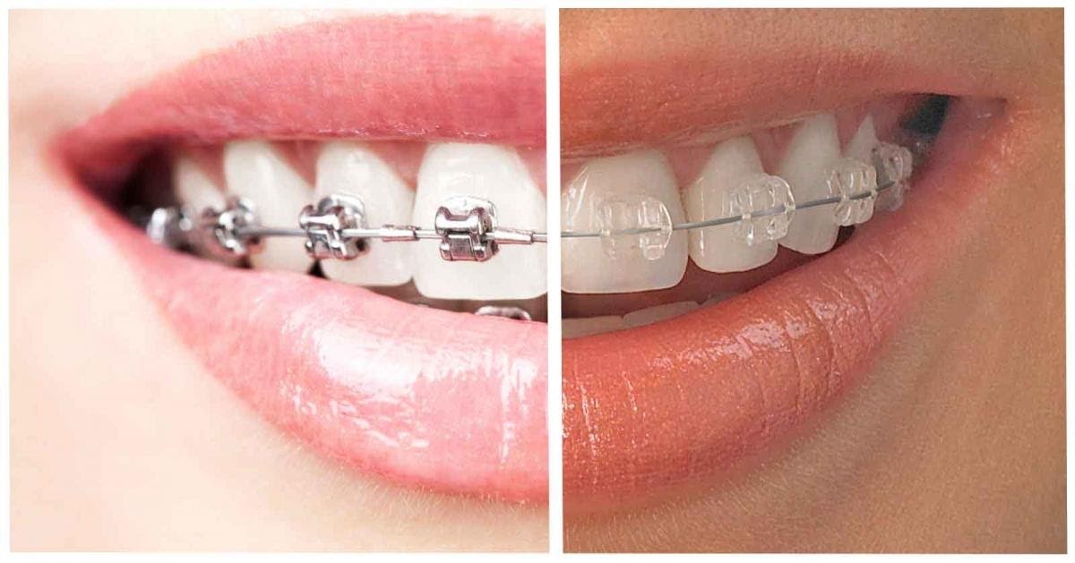 Invisible Teeth Aligners Vs Braces