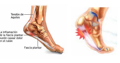 Me duele mucho los pies al caminar