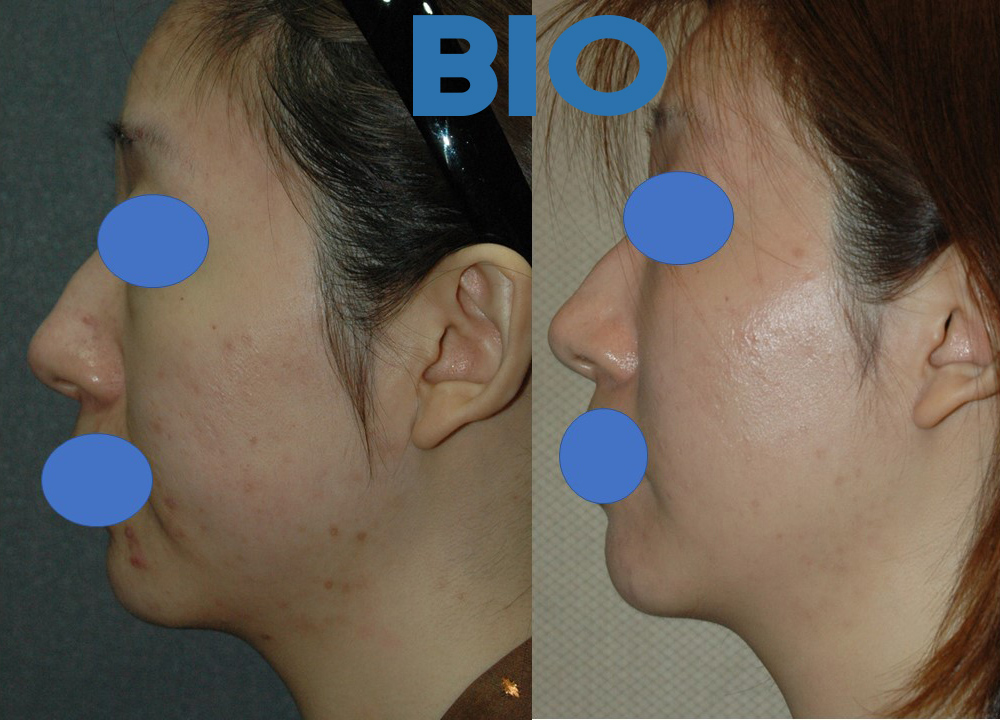 биос пластическая хирургия. биос пластическая хирургия. эндоскопический лифтинг ворошкевич. биос пластическая хирургия. биос пластическая хирургия.