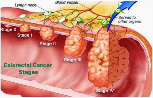 Diagnosed with Colon Cancer What next Medical Tourism
