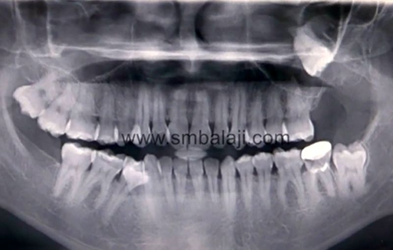 CLINICAL CASE Maxillary Dentigerous Cyst Surgery Wisdom Tooth