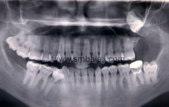 CLINICAL CASE: Maxillary Dentigerous Cyst Surgery - Wisdom Tooth Removal - Dr. Balaji