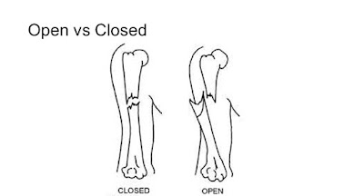 a patient underwent closed reduction of a closed fracture a patient underwent closed reduction of a closed fracture