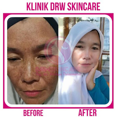 Paket Flek Hitam Drw Skincare