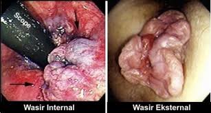 Foto Cari Obat Ambeyen Keluar Darah Saat BAB