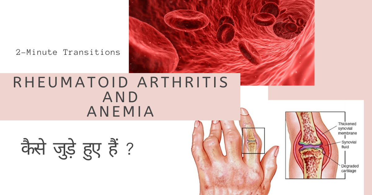 Rheumatoid Arthritis and Anemia जुड़े हुए हैं?